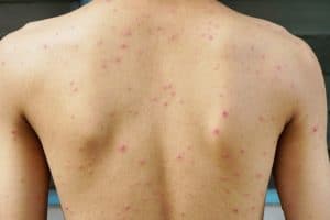North Carolina’s Chickenpox Outbreak Is Serious