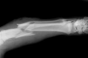 New Study Connects Broken Bones to an Increased Risk of Death