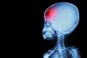 How to Determine if Your Child Suffered a Brain Injury